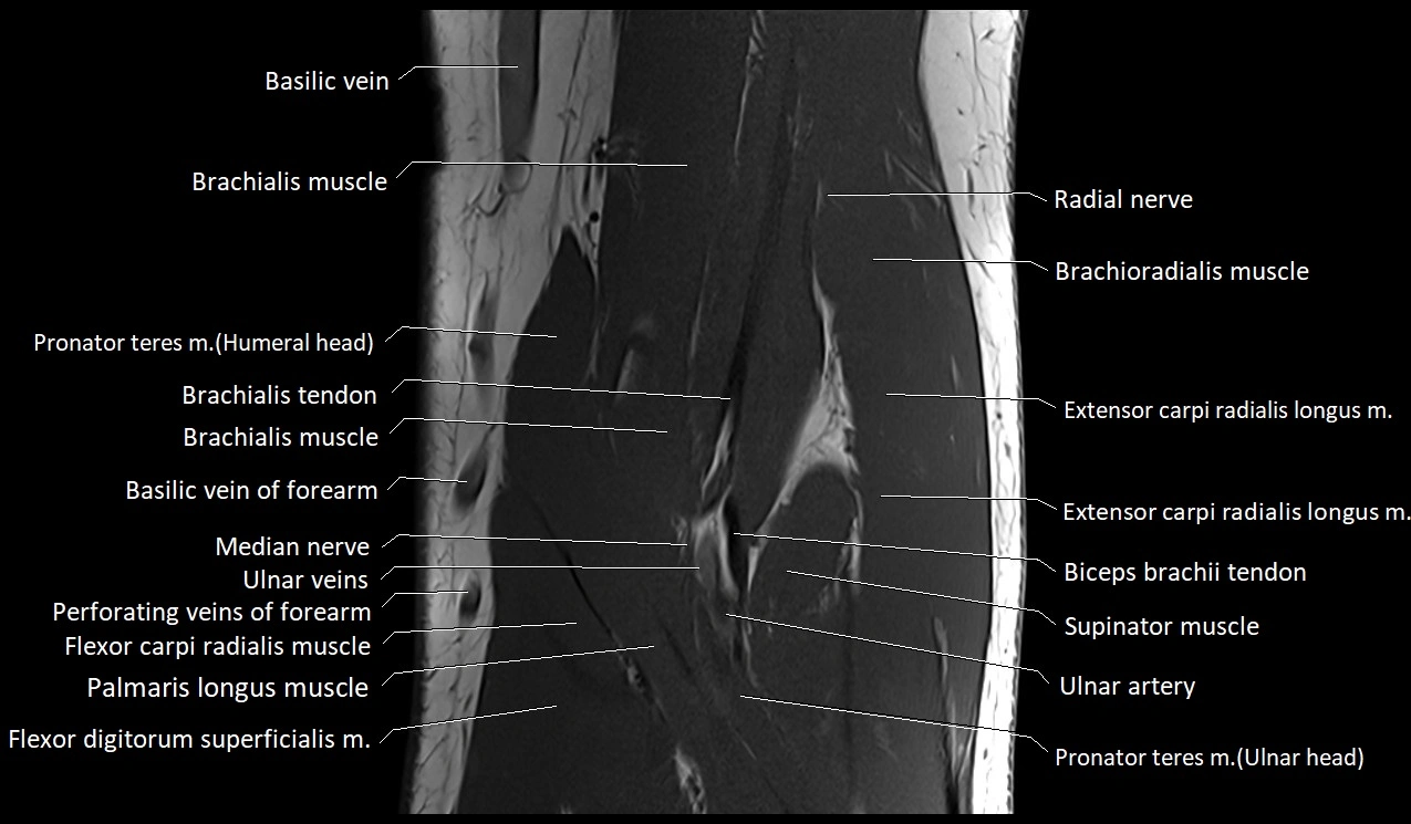 Elbow coronal anatomy image  cross sectional 3T MRI image 14.webp